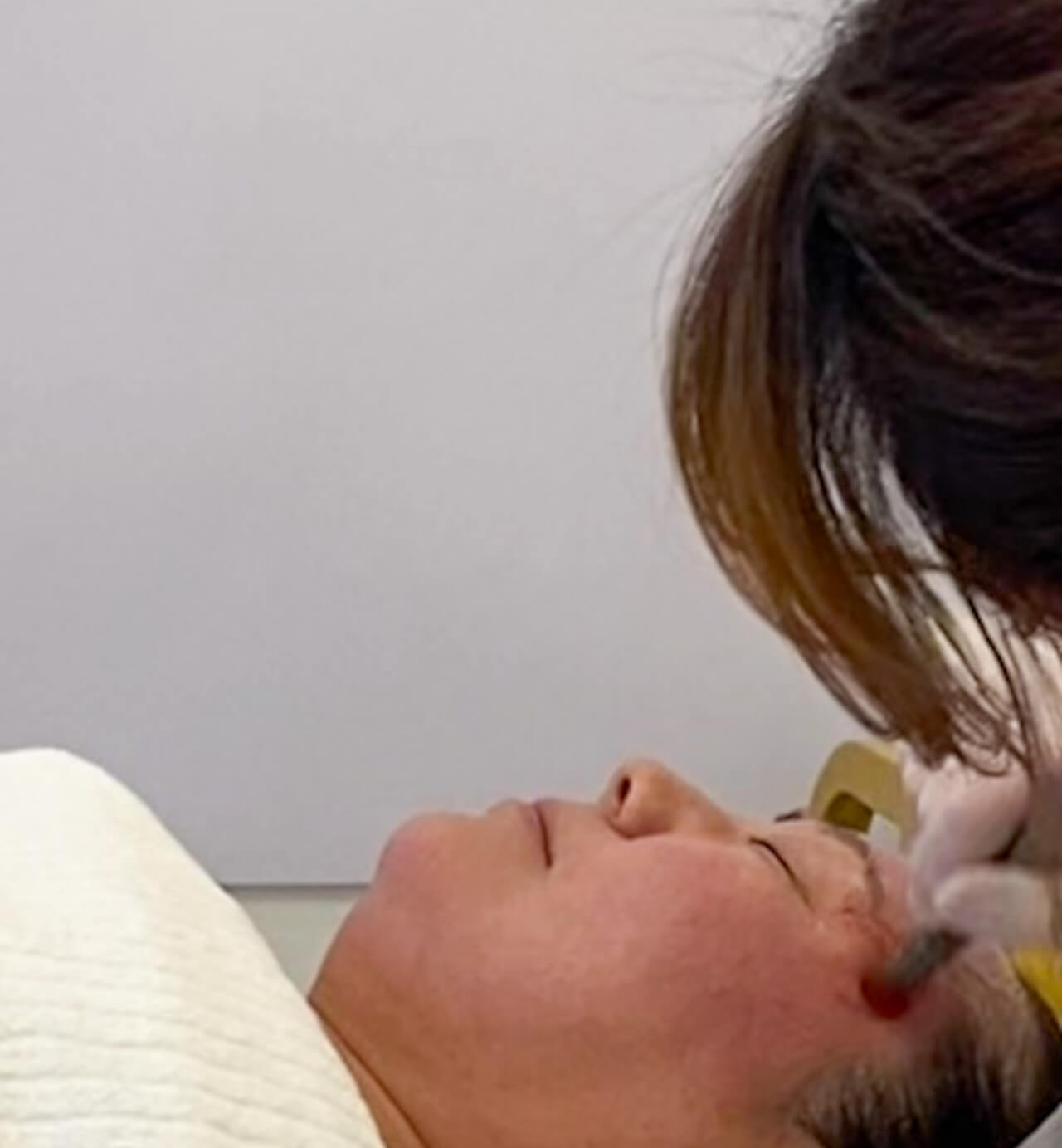 skin treatments in seoul | microneedling