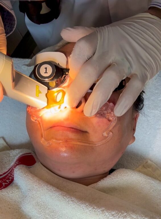 skin treatments in korea | Excel V laser