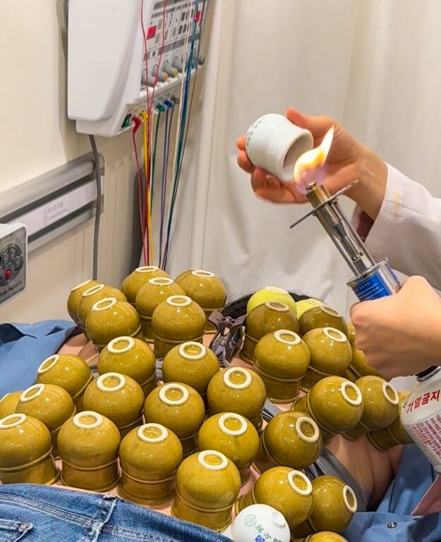 traditional fire cupping in seoul korea