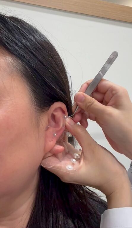 ear seeding in seoul