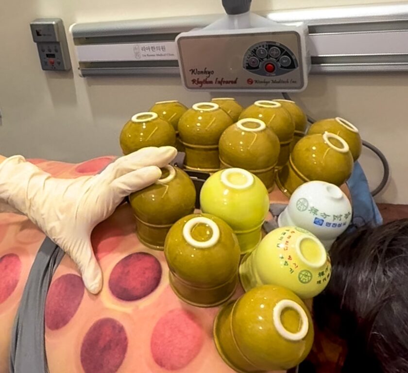 traditional fire cupping treatment in korea