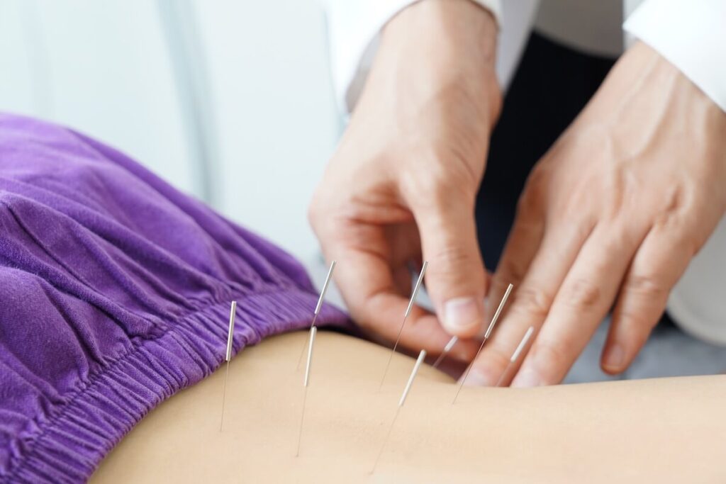 acupuncture treatment
